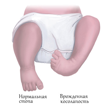 Лечение косолапости у детей по методике Понсети