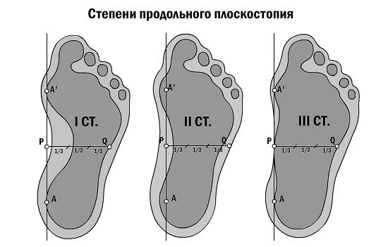 ПЛОСКОСТОПИЕ У ВЗРОСЛЫХ: ПРИЧИНЫ ВОЗНИКНОВЕНИЯ, МЕТОДЫ ЛЕЧЕНИЯ И ПРОФИЛАКТИКА