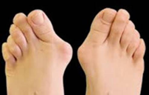 ЛЕЧЕНИЕ HALLUS VALGUS