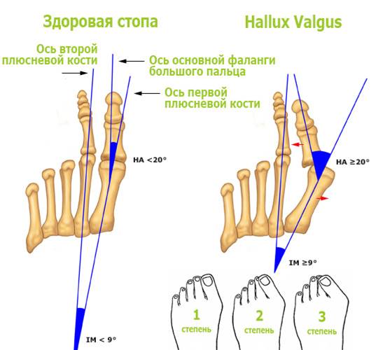 ЛЕЧЕНИЕ HALLUS VALGUS