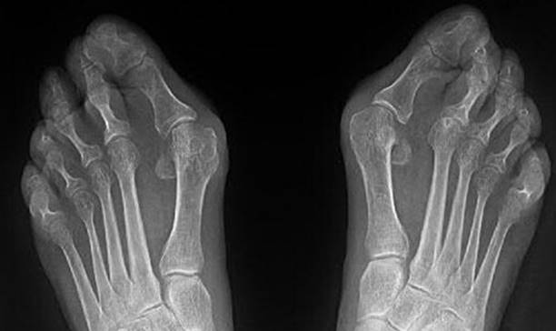 ЛЕЧЕНИЕ HALLUS VALGUS
