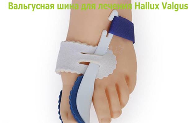ЛІКУВАННЯ HALLUS VALGUS